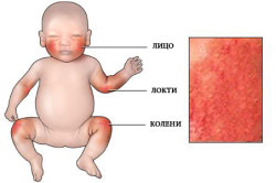 Места проявления аллергической реакции у ребенка