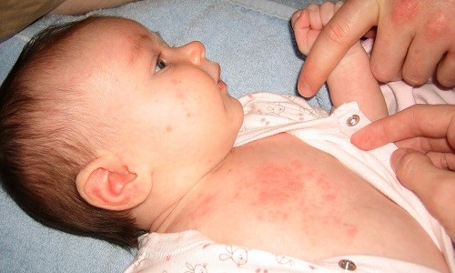Аллергитическая реакция на горох у новорожденных